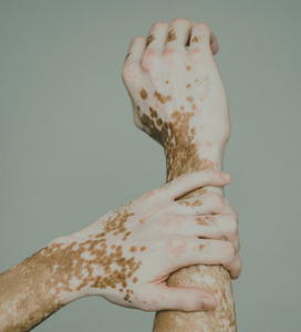 OXIDATIVE STRESS AND VITILIGO: WHAT'S THE CONNECTION? – GliSODin Int