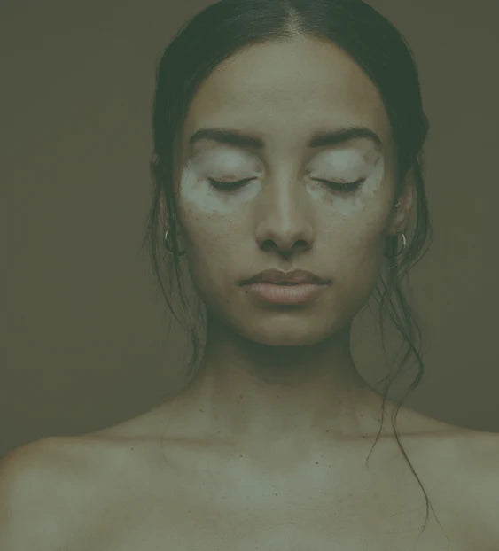 does glutathione cause vitiligo Vitiligo: interplay between oxidative stress and immune system Guess who? : r/BollyBlindsNGossip